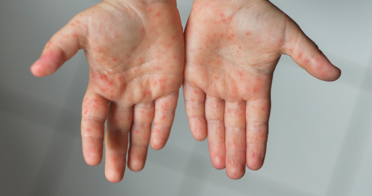 kéz-láb-száj betegség