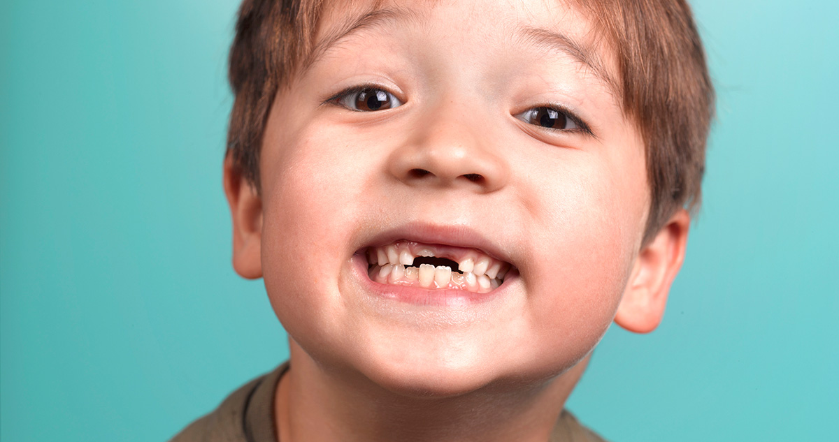 Kisfiú fogait mutatja, kihullott tejfogak