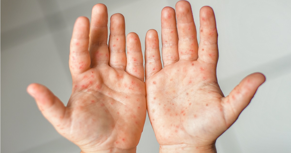 kéz-láb-száj fertőzés jele a kézen