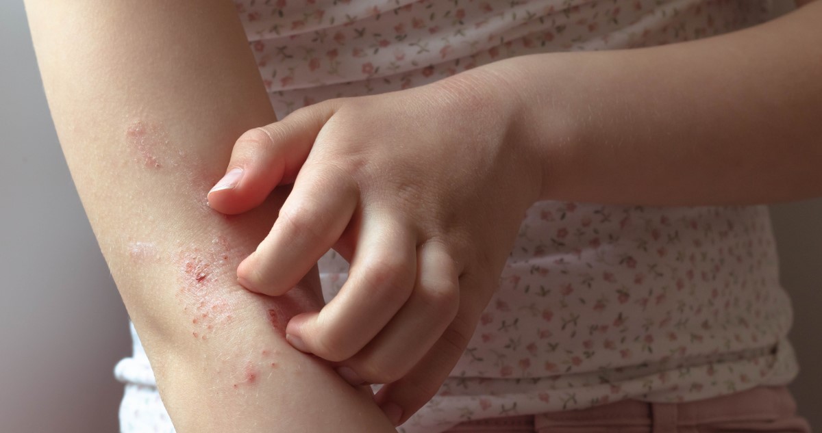 ekcema - Gyerekszoba ekcéma