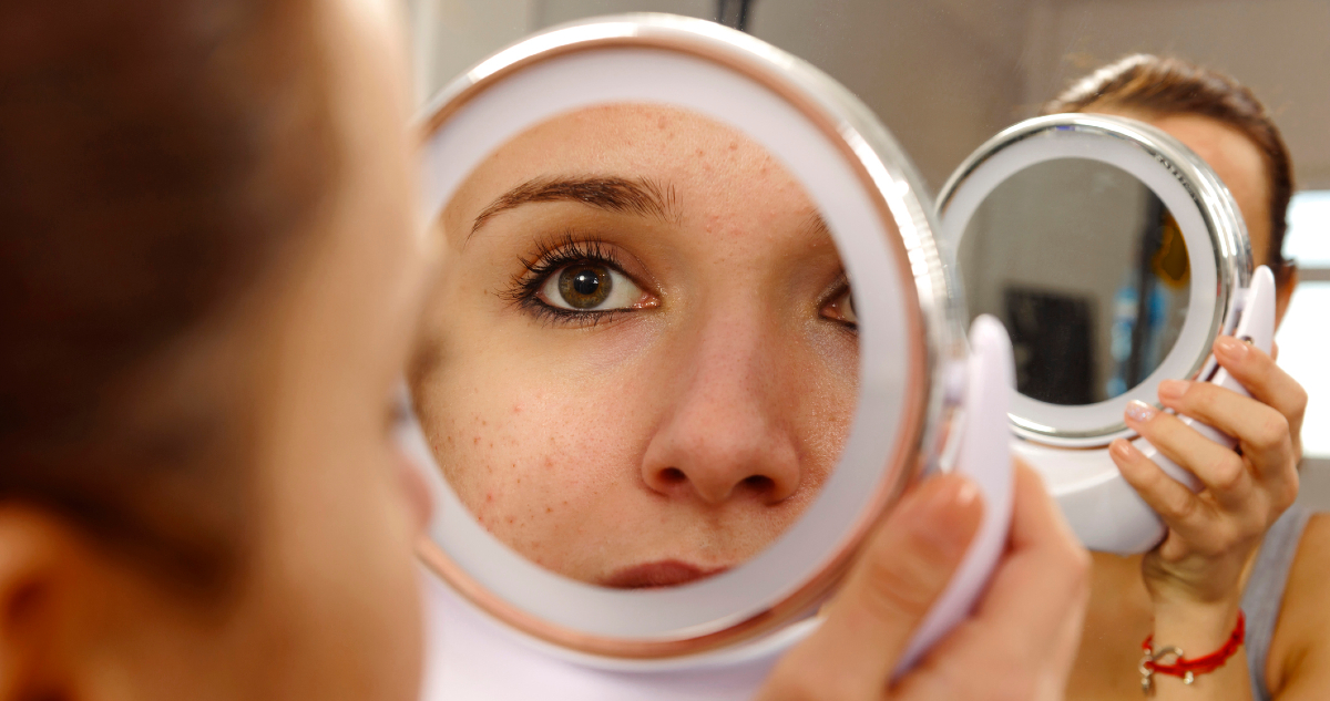 pattanás, betegség, arc