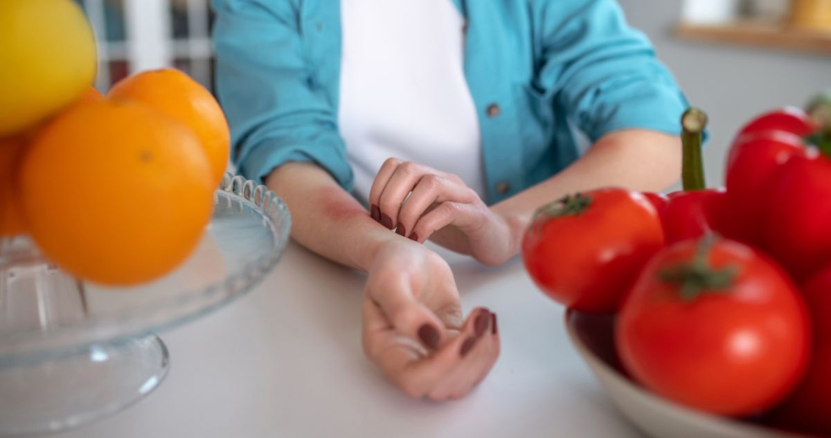 allergiaboron - Gyerekszoba nő alkarján kiütést vakar, karja az asztalon egy tál paradicsommal és egy másikon naranccsal