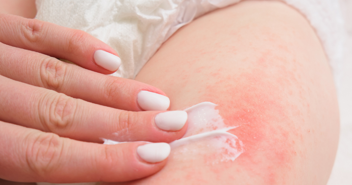 pelenkakiütés, kezelés