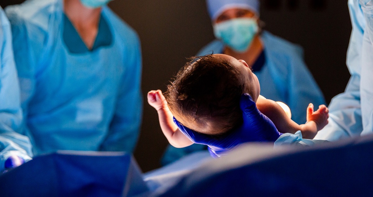 Szétválasztott sziámi ikrek