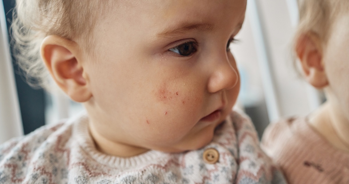 Kisbaba az arcán tipikus, atópiás dermatitiszes folttal