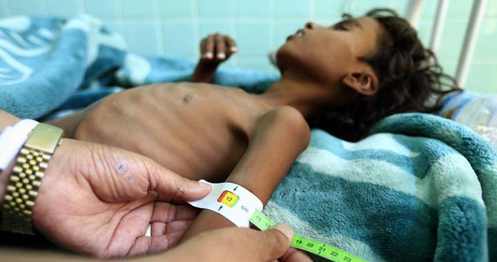 Jemen: kórházban ápolt gyerekek élete forog veszélyben