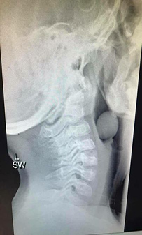 Tanulságos röntgenkép - Félrenyelt a gyerek